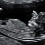 Αυχενική διαφάνεια